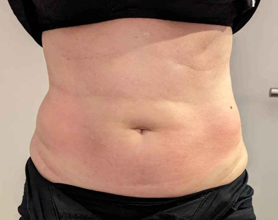 Nachher-Aufnahme Cryo-BodyShape, Zone Bauch