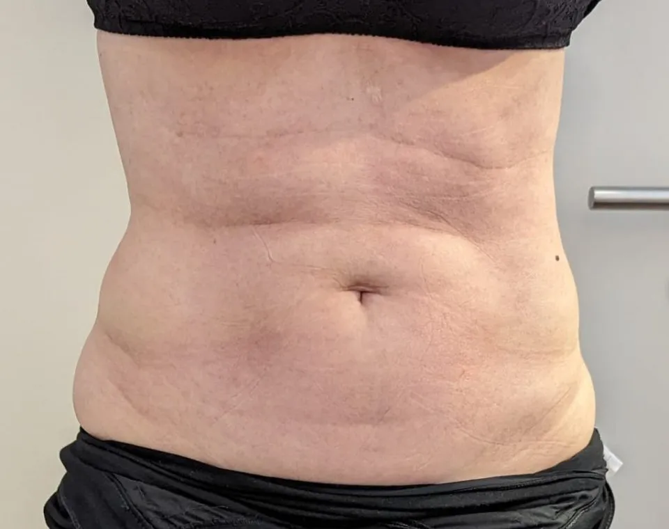 Vorher-Aufnahme Cryo-BodyShape, Zone Bauch