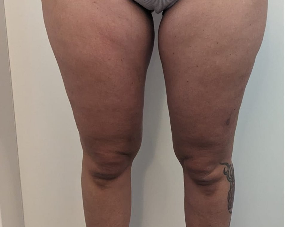 Nachher-Aufnahme Cryo-BodyShape, Zone Beine