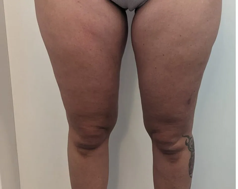 Nachher-Aufnahme Cryo-BodyShape, Zone Beine