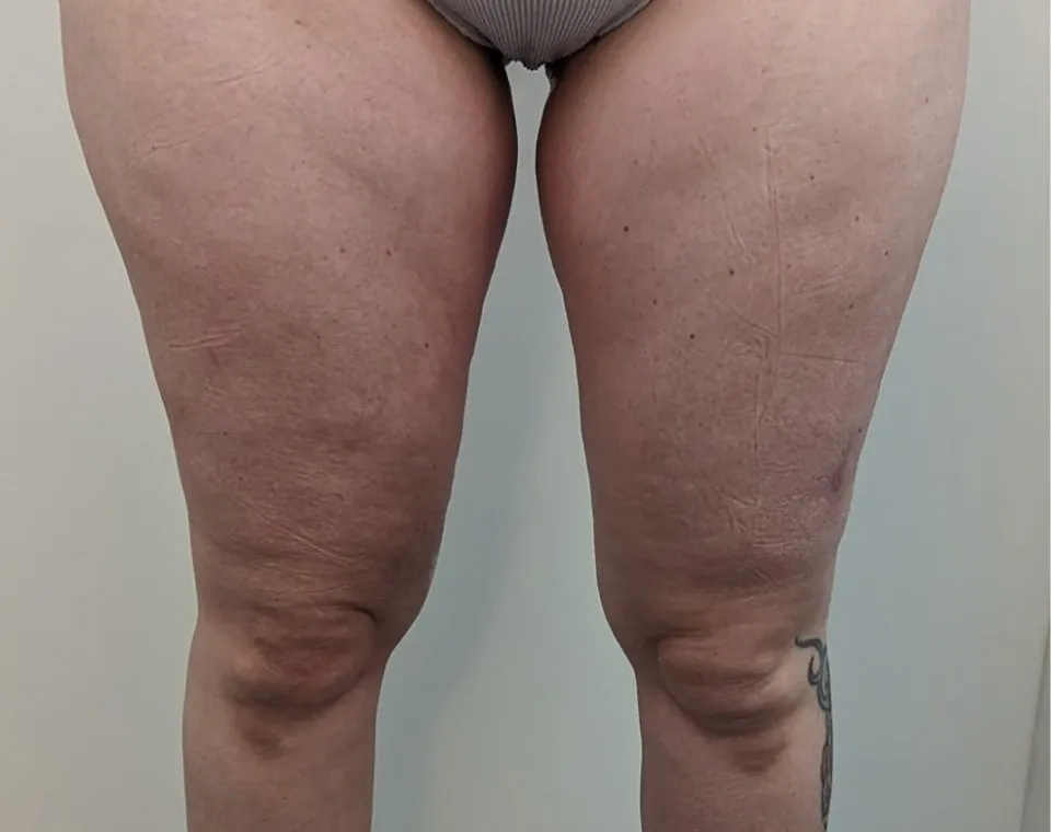 Vorher-Aufnahme Cryo-BodyShape, Zone Beine