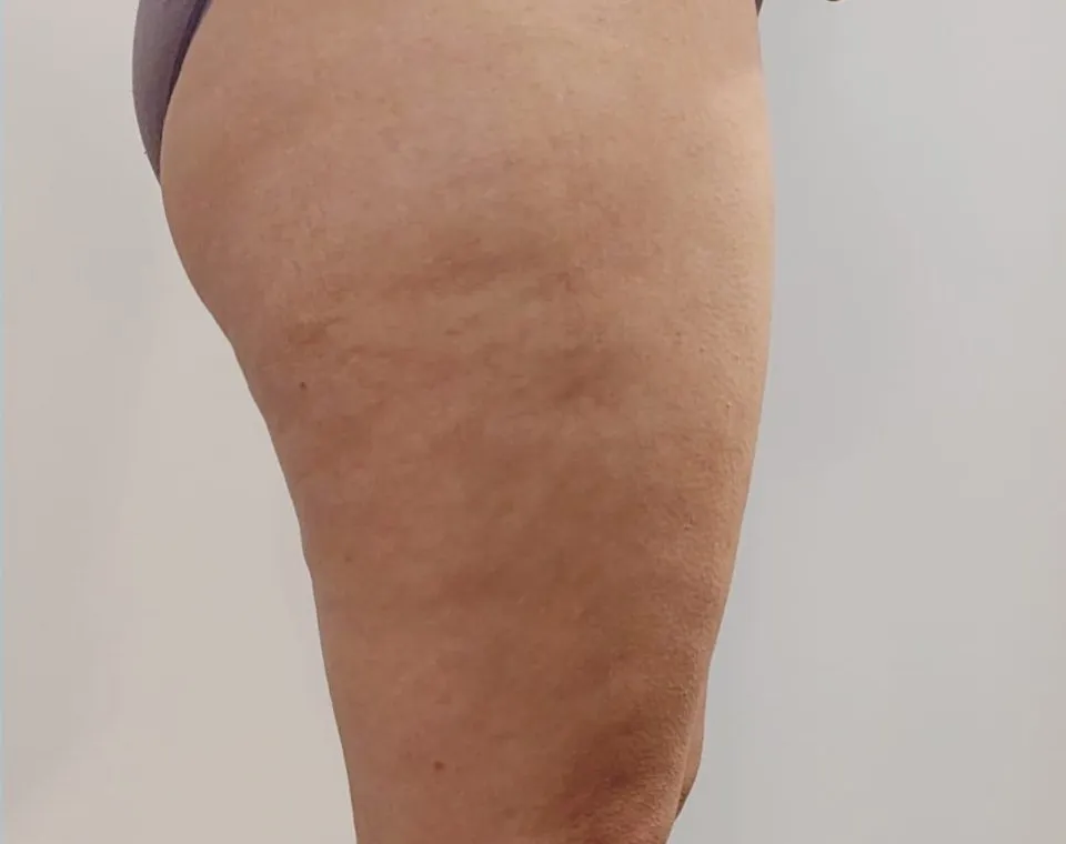 Nachher-Aufnahme Cryo-BodyShape, Zone Oberschenkel