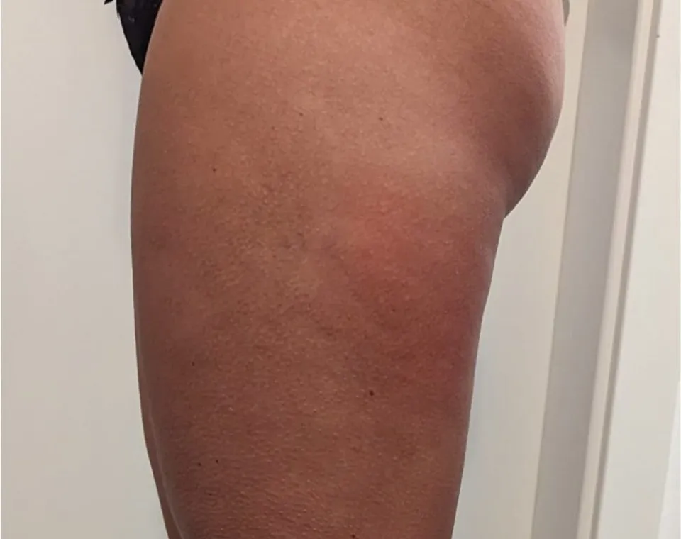 Nachher-Aufnahme Cryo-BodyShape, Zone Po