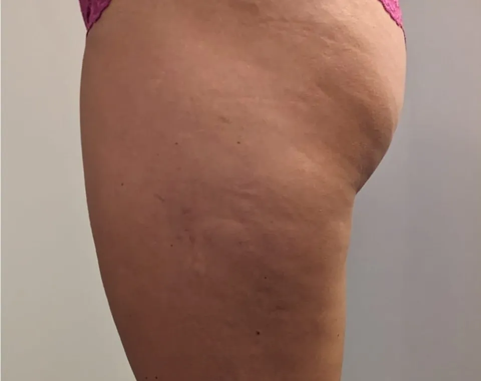 Vorher-Aufnahme Cryo-BodyShape, Zone Po