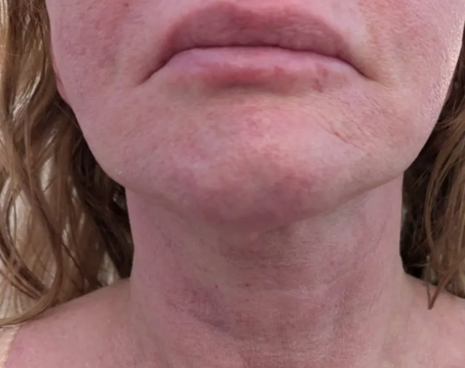 Nachher-Aufnahme Cryo-Facial, Zone Hals