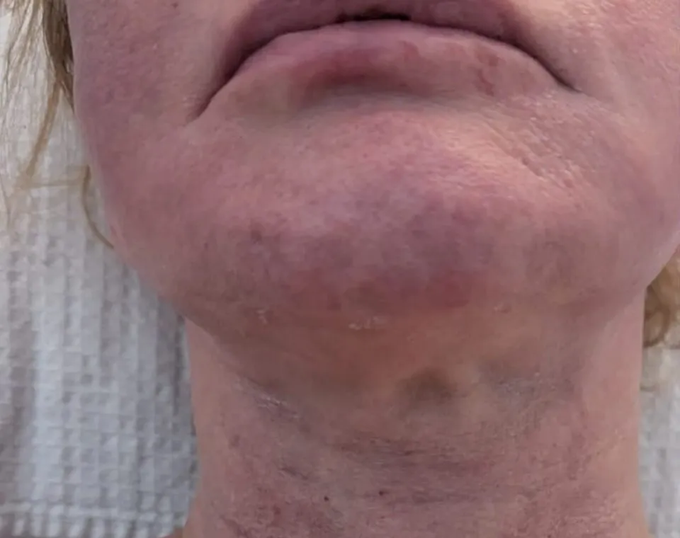 Vorher-Aufnahme Cryo-Facial, Zone Hals