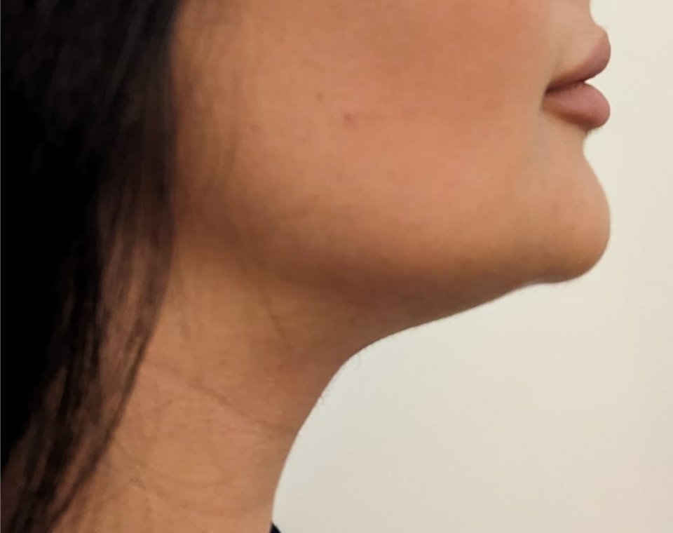 Nachher-Aufnahme Cryo-Facial, Zone Kinnlinie