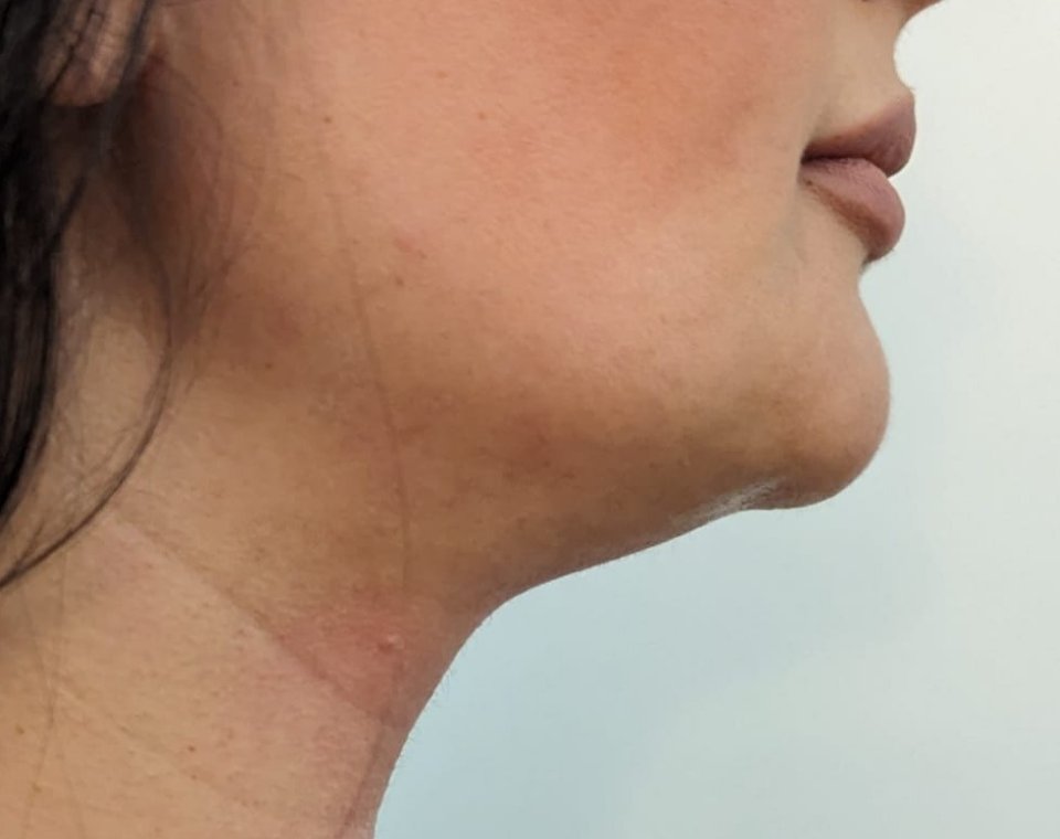 Vorher-Aufnahme Cryo-Facial, Zone Kinnlinie