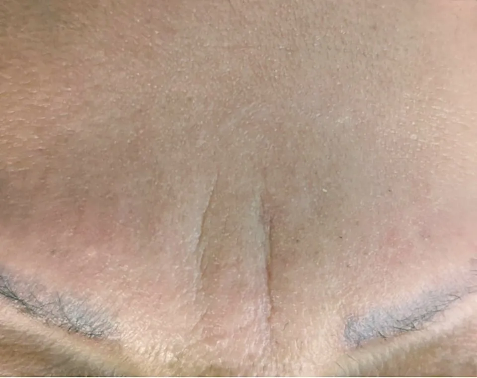 Nachher-Aufnahme Cryo-Facial, Zone Stirn