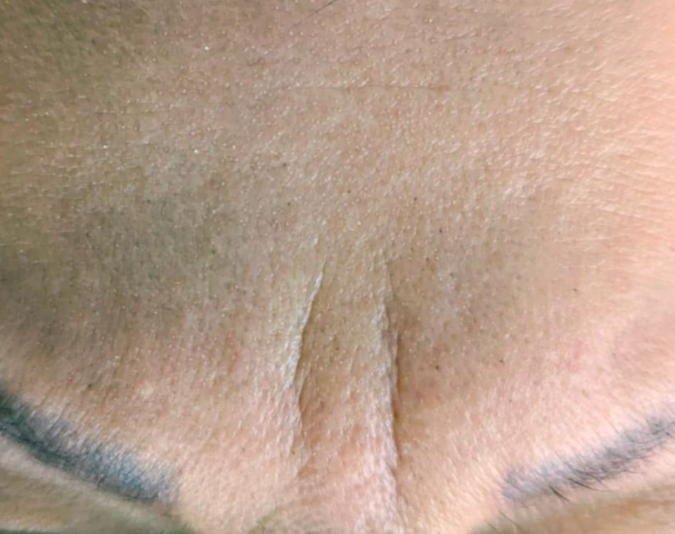 Vorher-Aufnahme Cryo-Facial, Zone Stirn