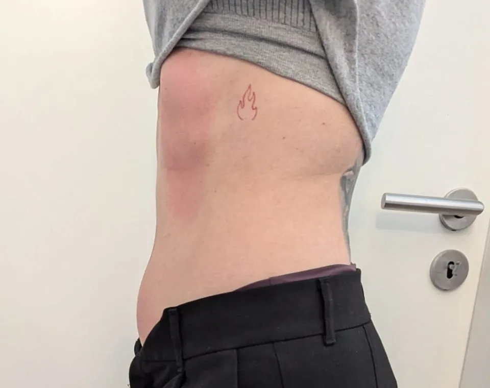 Nachher-Aufnahme Cryo-Lipolyse, Zone Bauch