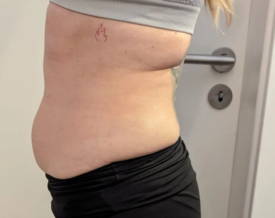 Vorher-Aufnahme Cryo-Lipolyse, Zone Bauch
