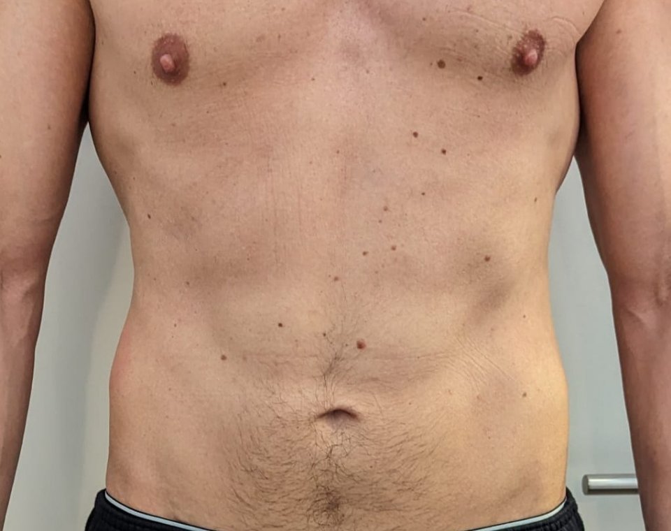 Nachher-Aufnahme Cryo-Lipolyse, Zone Bauch