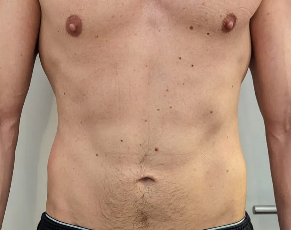 Nachher-Aufnahme Cryo-Lipolyse, Zone Bauch