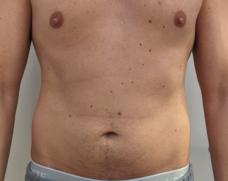 Vorher-Aufnahme Cryo-Lipolyse, Zone Bauch