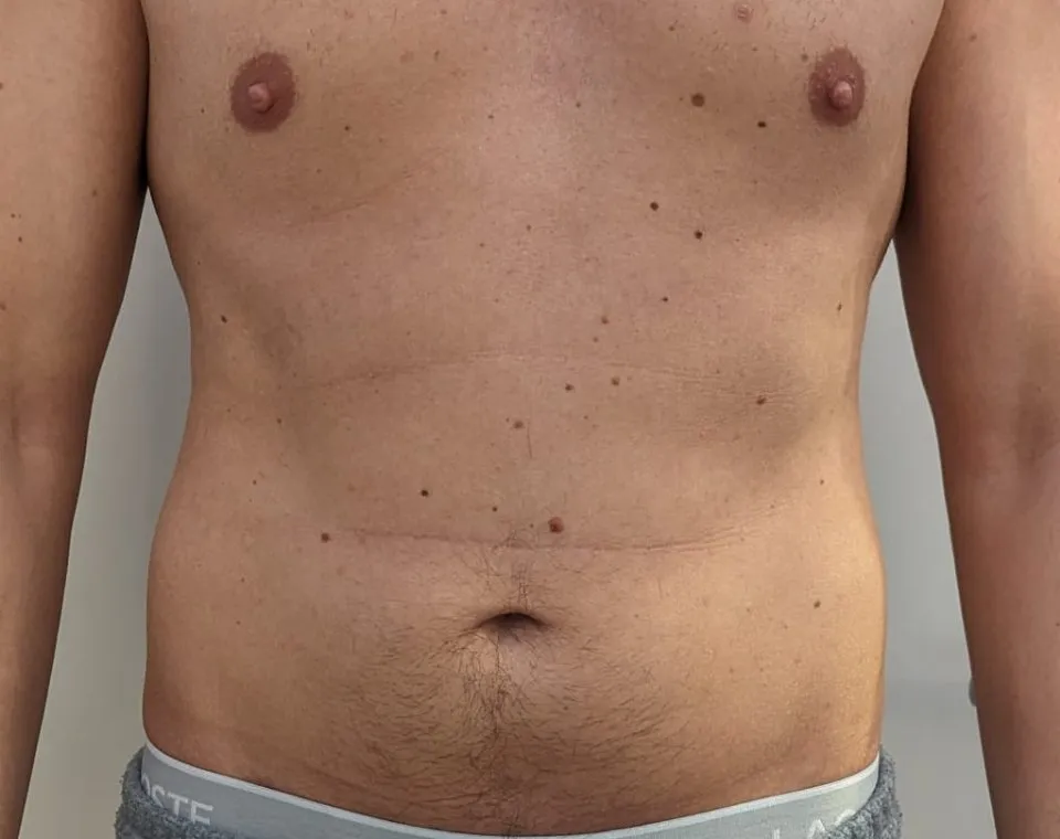 Vorher-Aufnahme Cryo-Lipolyse, Zone Bauch