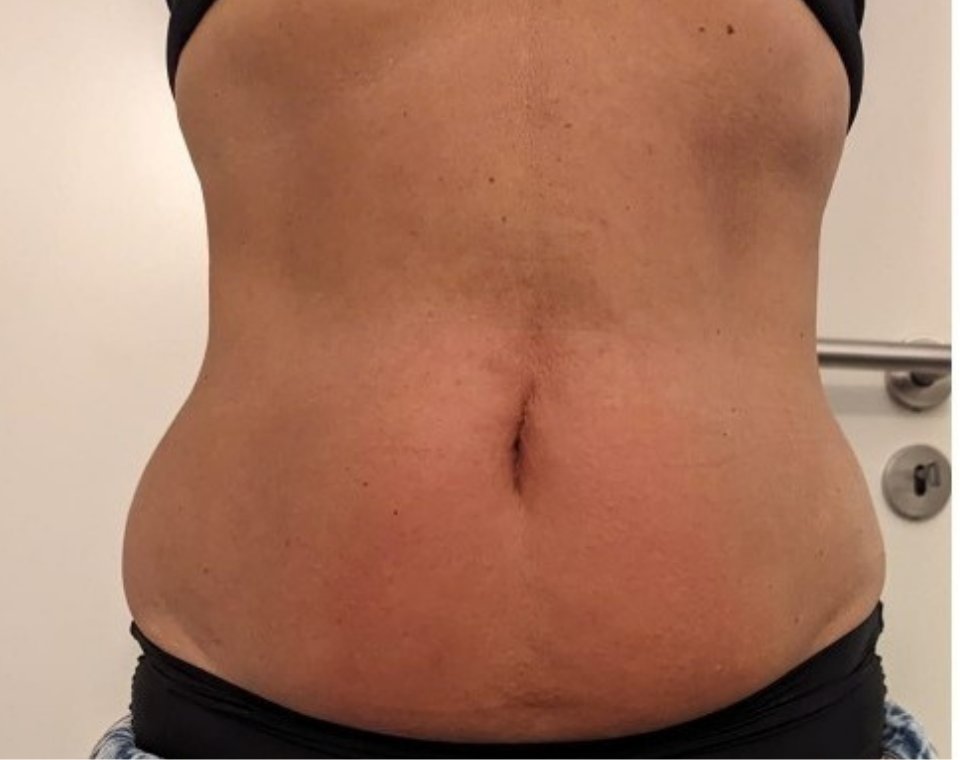 Nachher-Aufnahme Cryo-Lipolyse, Zone Bauch