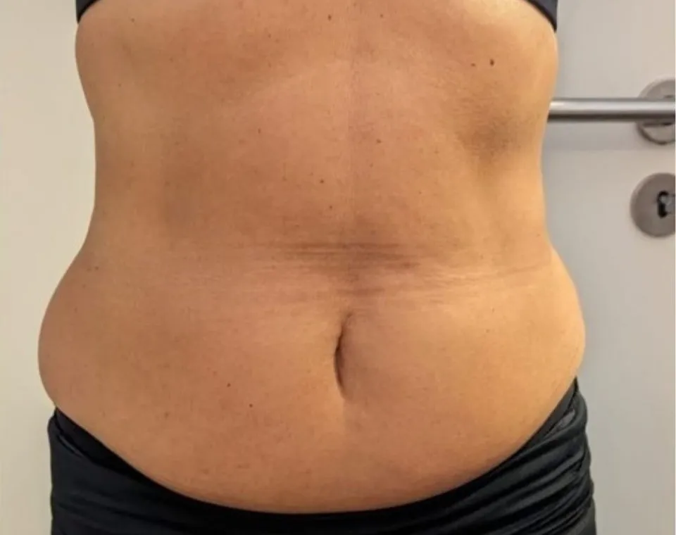 Vorher-Aufnahme Cryo-Lipolyse, Zone Bauch